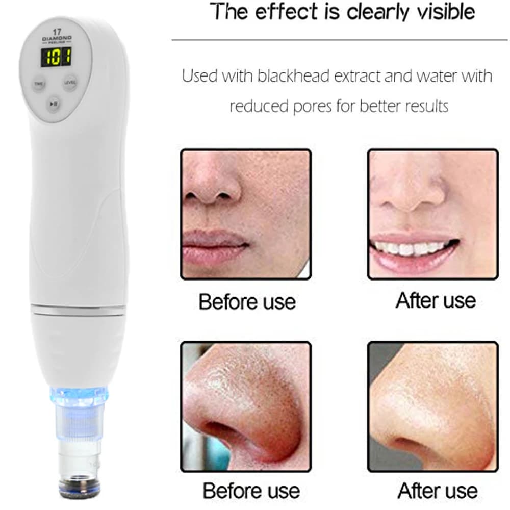 DermDelhi-Machine de peeling de la peau sous vide pour le visage, points noirs, élimination de l'acn