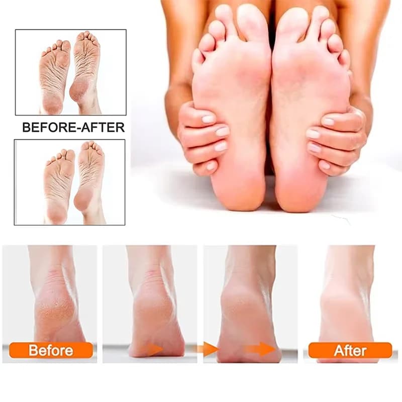 Lime Électrique Rechargeable pour les Pieds, Appareil de Pédicure, Dissolvant de Callosités, Outils 
